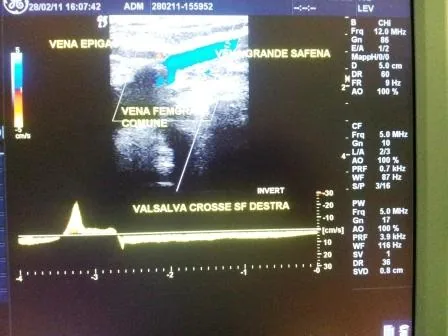 eco color doppler che evidenzia una crosse safeno femorale e cioè anatomicamente lo sbocco della vena grande safena nella vena femorale comune.